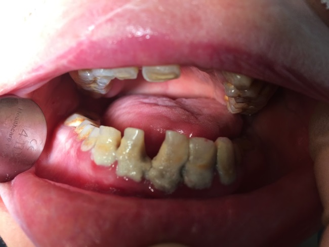 Patient Case Poor Oral Health Patient Case Poor Oral Health